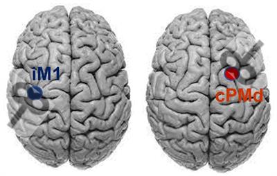 High-definition transcranial direct current stimulation for upper extremity rehabilitation in moderate-to-severe ischemic stroke: a pilot study